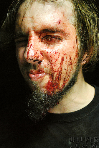 Bloody Chip Fracture