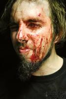 Bloody Chip Fracture